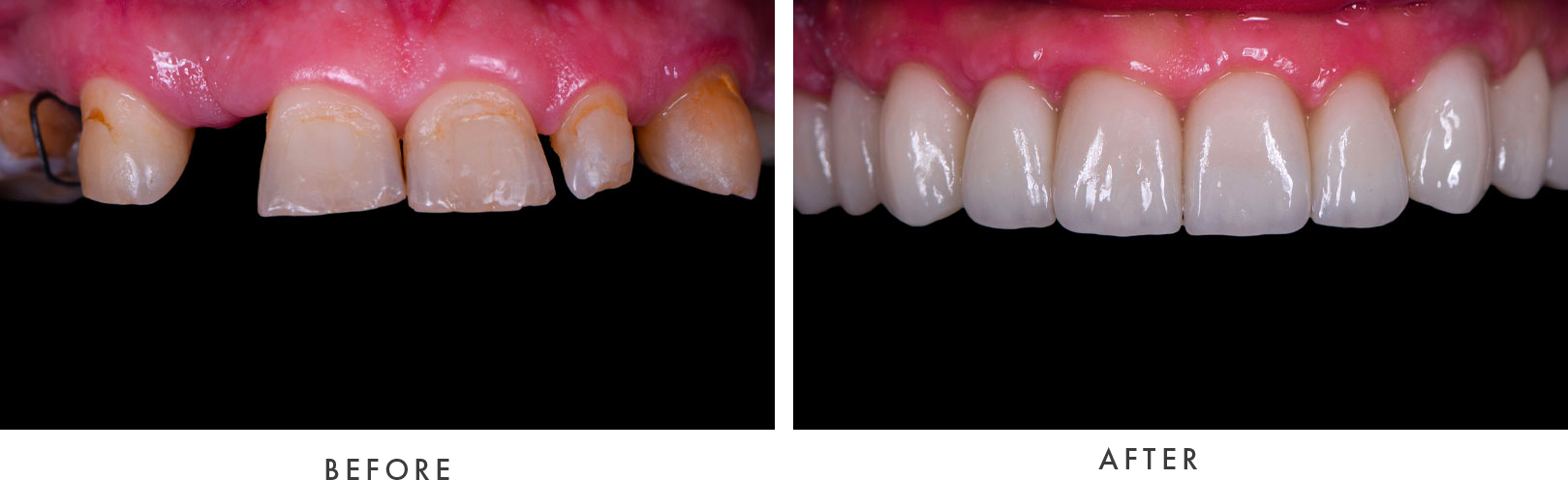 Full Mouth Dental Implants