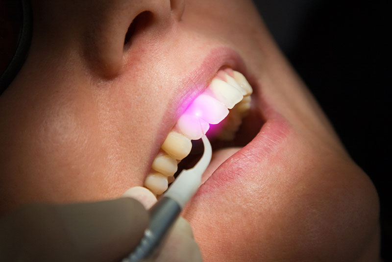 dentist using laser to perform LAPIP surgery