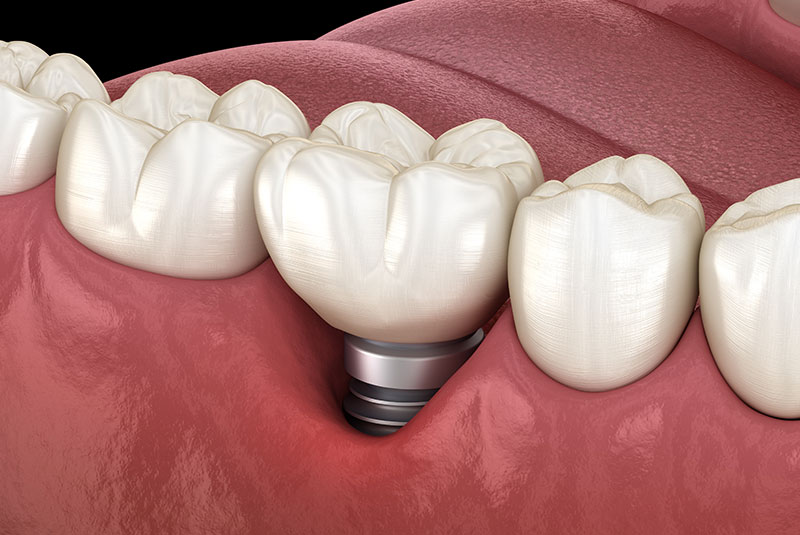 3D illustration of peri implantitis