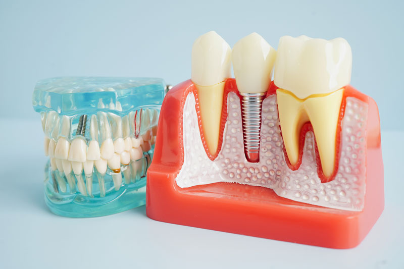 Unveiling the Mystery of Implant Dentistry in Somerville, MA