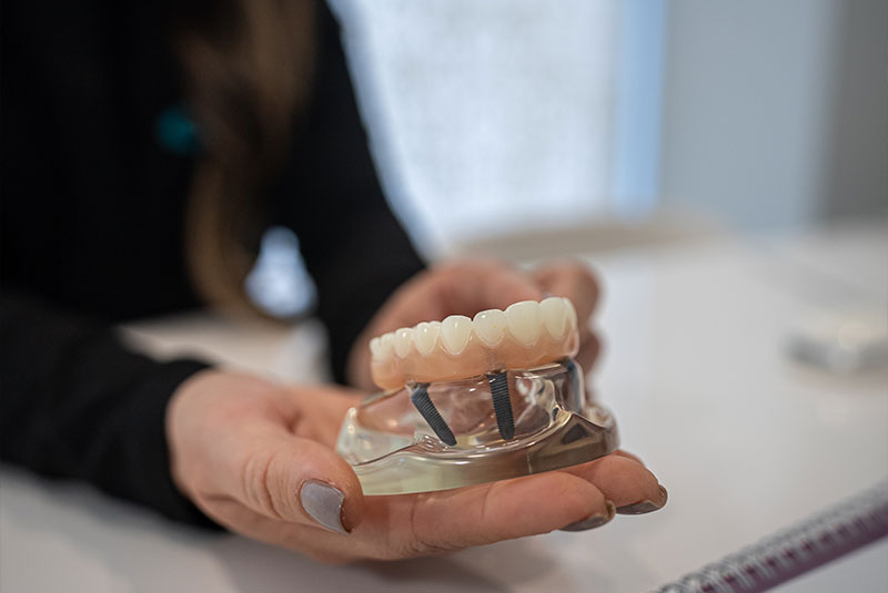 full arch dental implant model