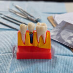 Dental implant, artificial tooth roots into jaw, root canal of dental treatment, gum disease, teeth model for dentist