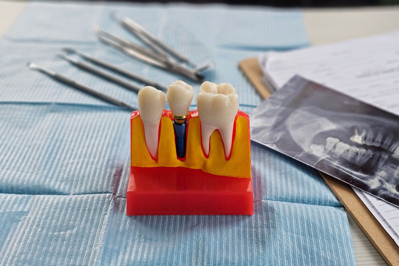 Exploring Dental Implants as a Superior Option for Reliable Fake Teeth Replacement