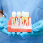Doctor hold dental implant, artificial tooth roots into jaw, root canal of dental treatment, gum disease, teeth model for dentist studying about dentistry