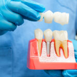 A dental professional wearing blue gloves holds a model showing a dental implant in the jawbone, demonstrating how a bridge fits over the implant and natural teeth.