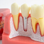 Dental implant, artificial tooth roots into jaw, root canal of dental treatment, gum disease, teeth model for dentist studying about dentistry.