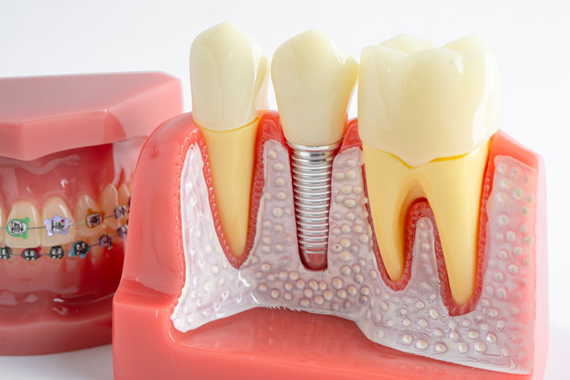 Transform Your Smile with a Front Tooth Implant: A Step-by-Step Dental Guide